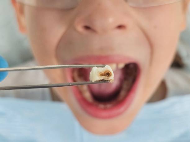 Best Emergency Tooth Extraction in Conneaut, OH