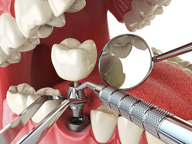 Best Emergency Wisdom Teeth Removal in Conneaut, OH